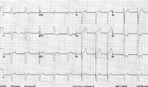 lv overload or aspecific change|life expectancy with lvh.